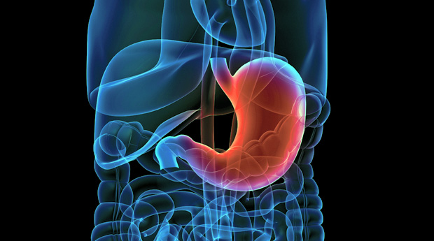 Язва желудка