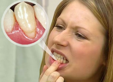 Рецессия десны