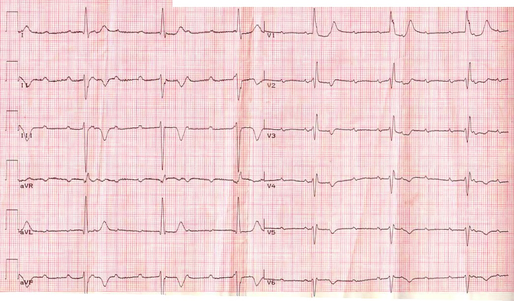 Атриовентрикулярная блокада