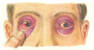 Перелом черепа