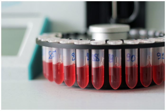 Системная красная волчанка
