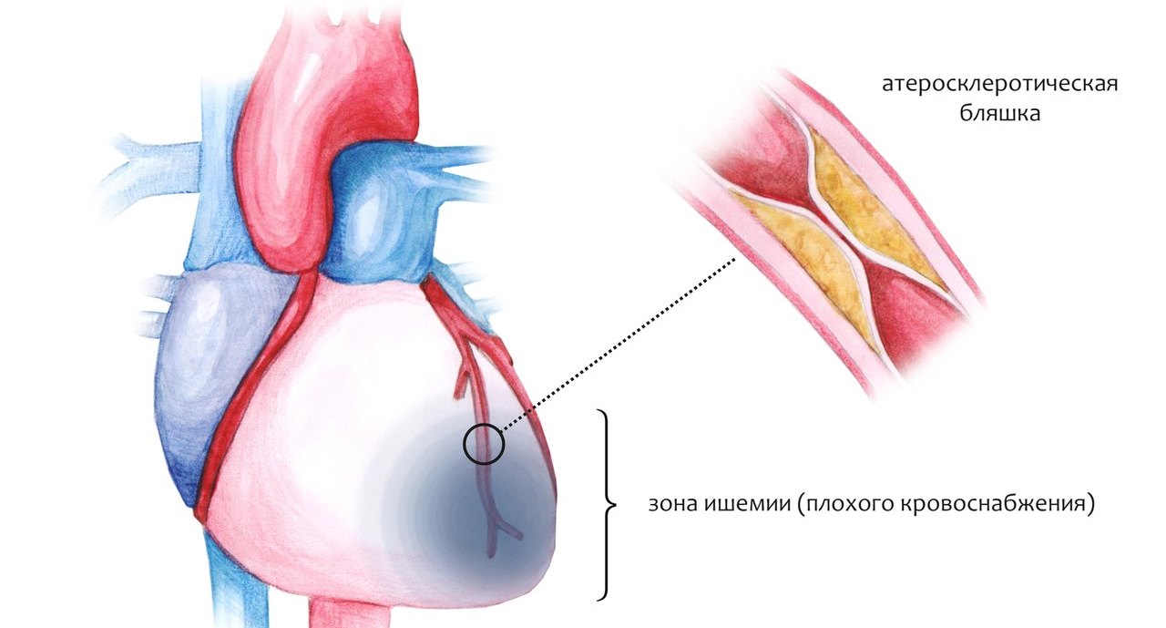 Ишемическая болезнь сердца