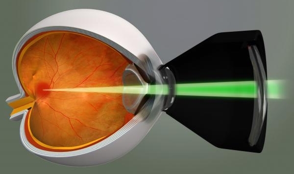 Диабетическая ретинопатия