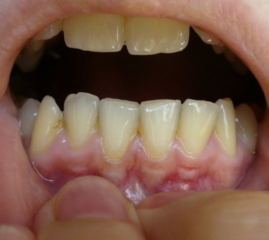 Пародонтоз