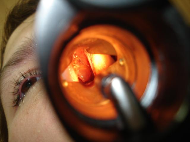 Гипертрофический ринит