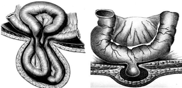 Паховая грыжа? Не откладывайте операцию!