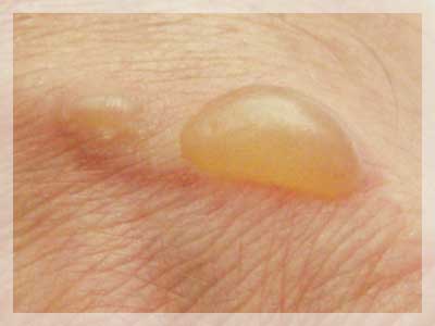 Пемфигоид (буллёзный)