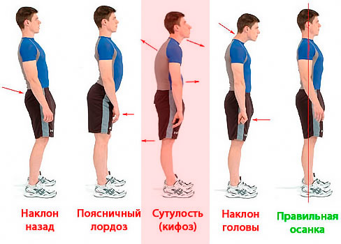 Нарушение осанки