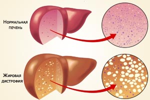 Жировая дегенерация печени