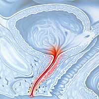 Уретральный синдром (уретрит)