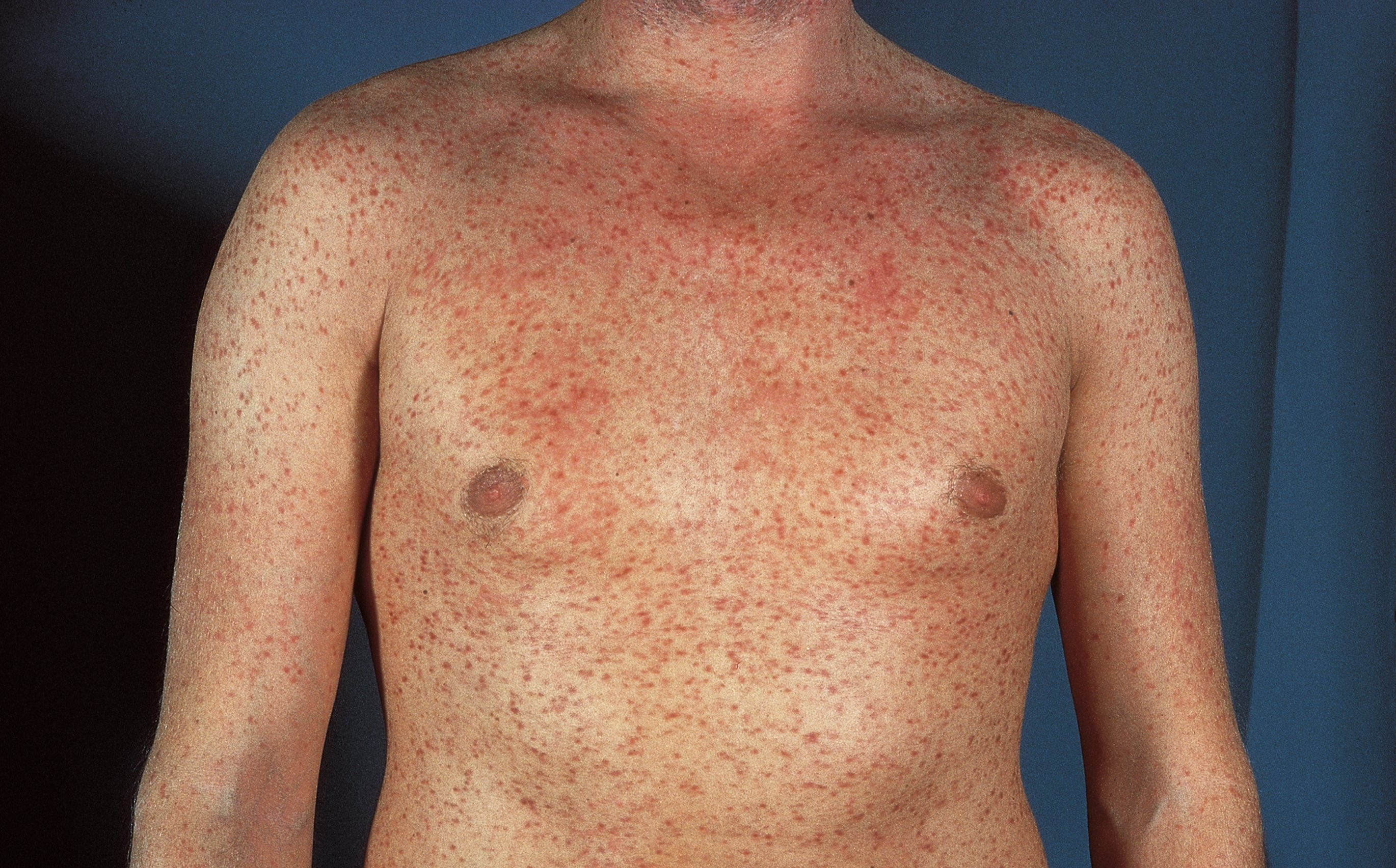 Мастоцитоз