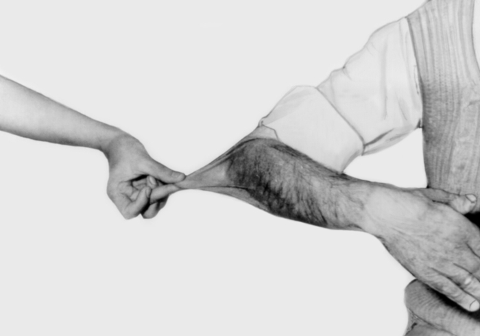 Синдром Элерса-Данлоса