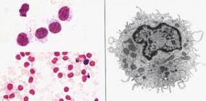 Волосатоклеточный лейкоз