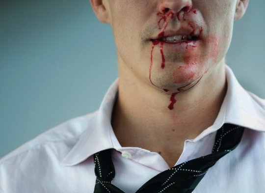 Кровотечение из носа: топ 5 причин