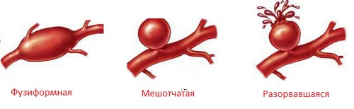 Как не спутать аневризму сосудов головного мозга с мигренью?