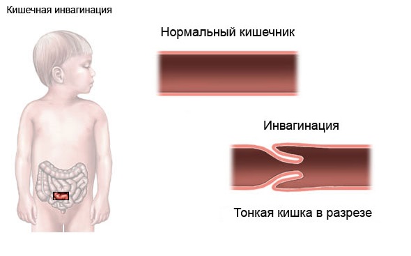 Инвагинация кишечника у детей