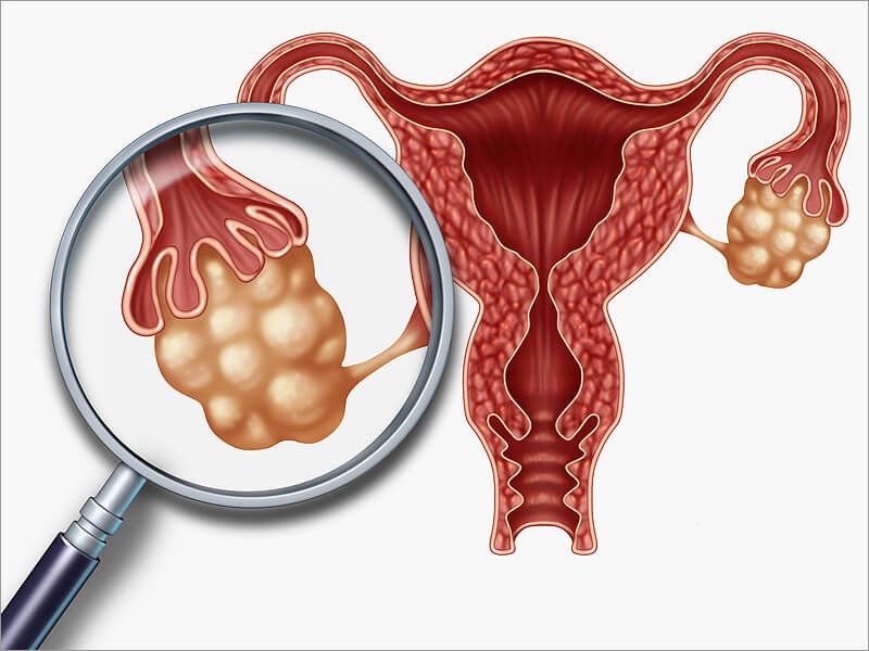 Поликистоз яичников: лечение