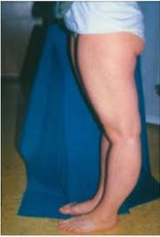 Дети с дисплазией соединительной ткани: много проблем и один ключ к ним.Часть 2.