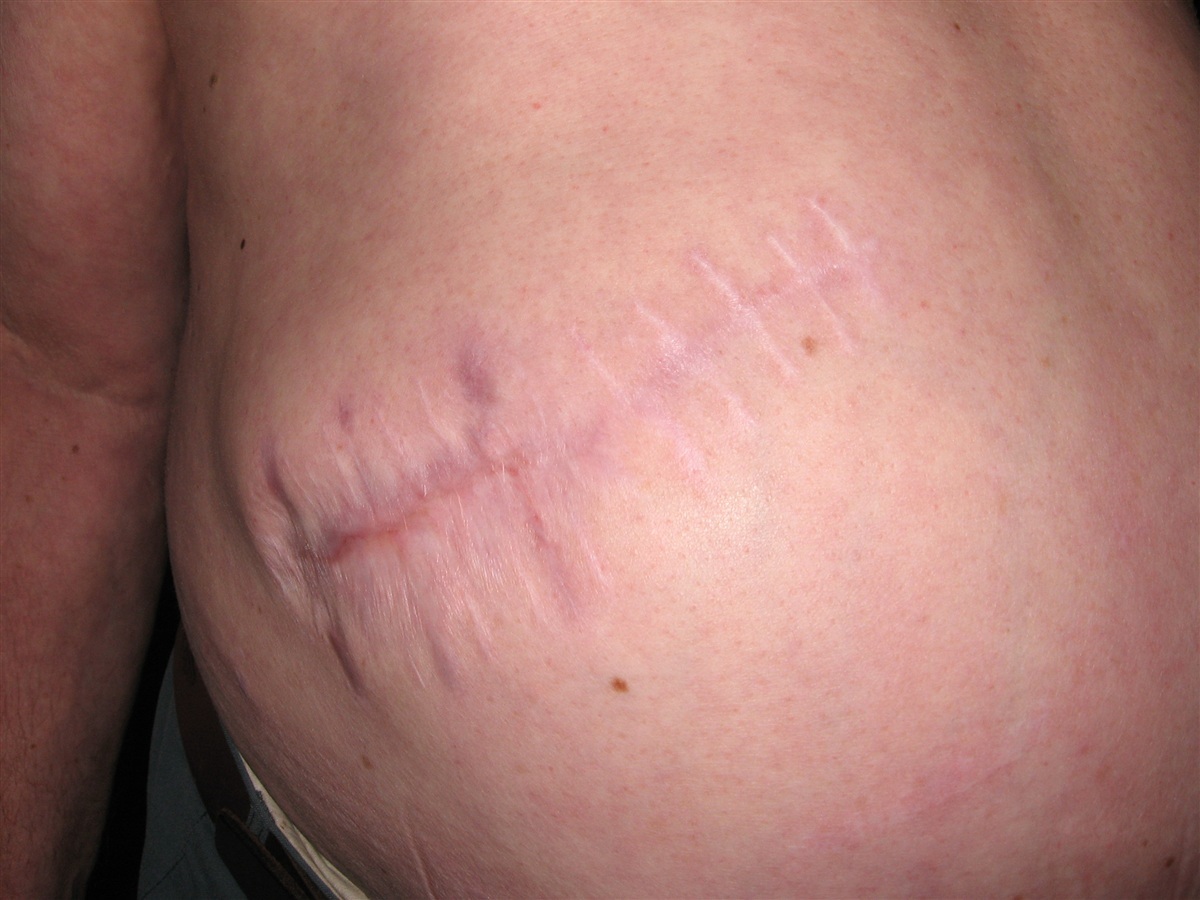 Послеоперационная грыжа