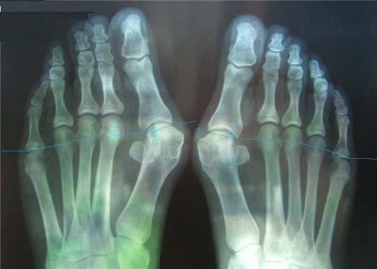 Вальгусная деформация пальцев стопы