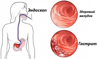 Острый гастрит