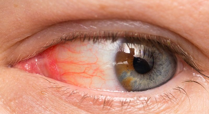 Синдром Рейтера