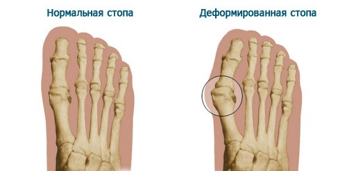 Вальгусная деформация