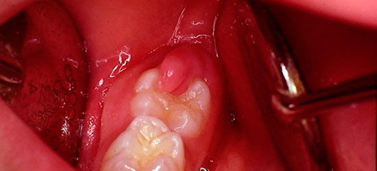 Перикоронит