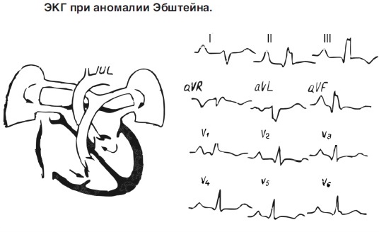Аномалия Эбштейна