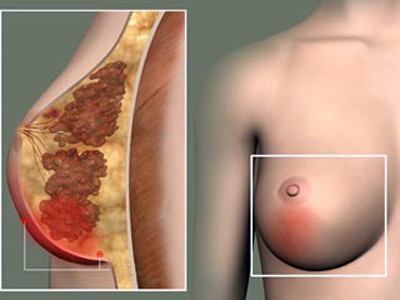Воспаление молочной железы (мастит)