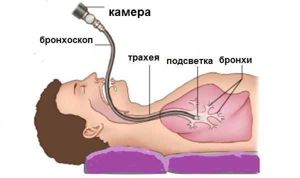 Аспергиллез