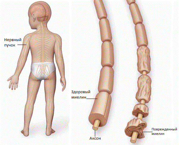 Синдром Гийена-Барре