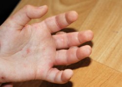 Как правильно обрабатывать волдыри после ожога