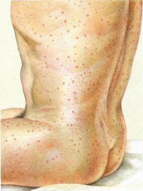 Болезнь Брилла