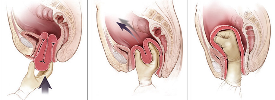 Выворот матки