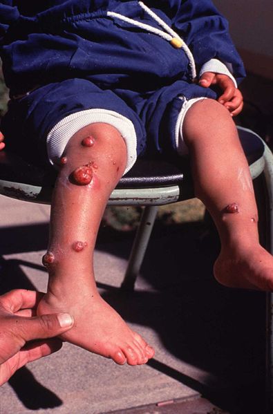 Бартонеллез