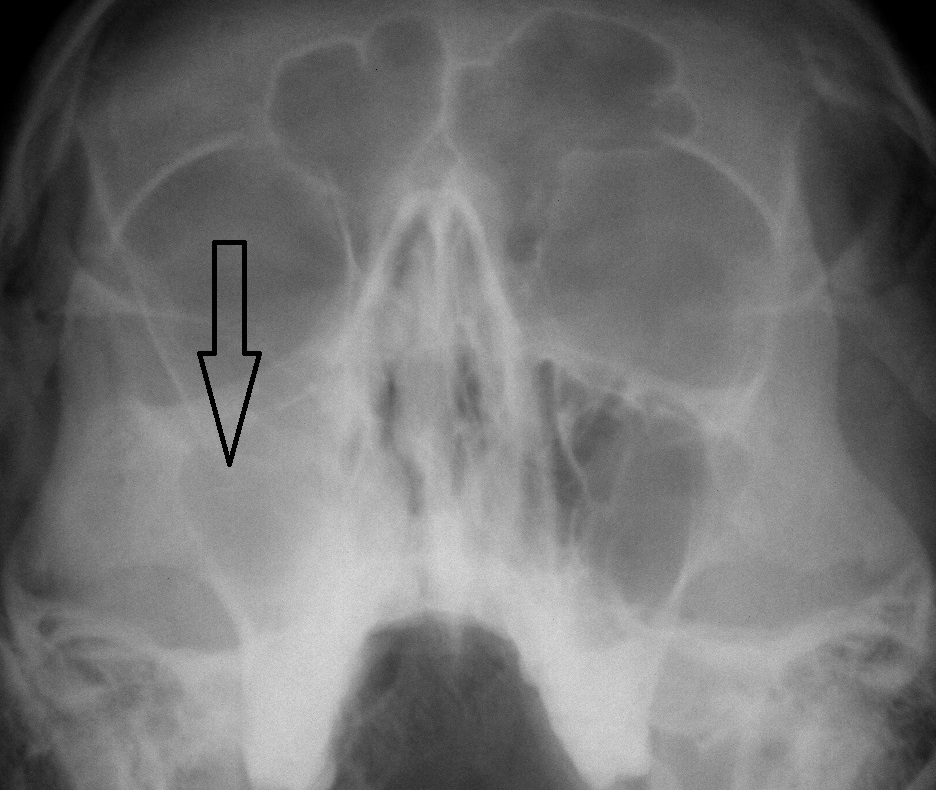 Пневматизация. Рентген пазух носа гайморит снимки. Хронический синусит рентген. Рентген снимок пазух носа с гайморитом.