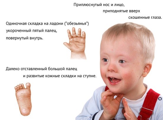 Синдром Дауна