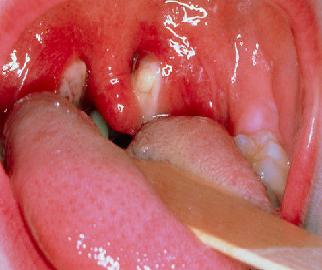 Мононуклеоз