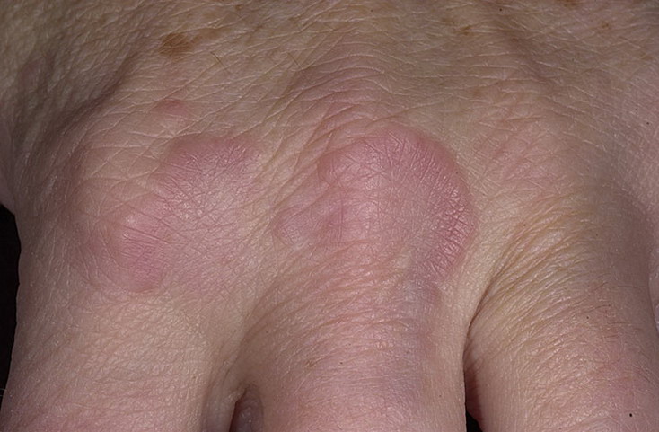 Гранулема кольцевидная