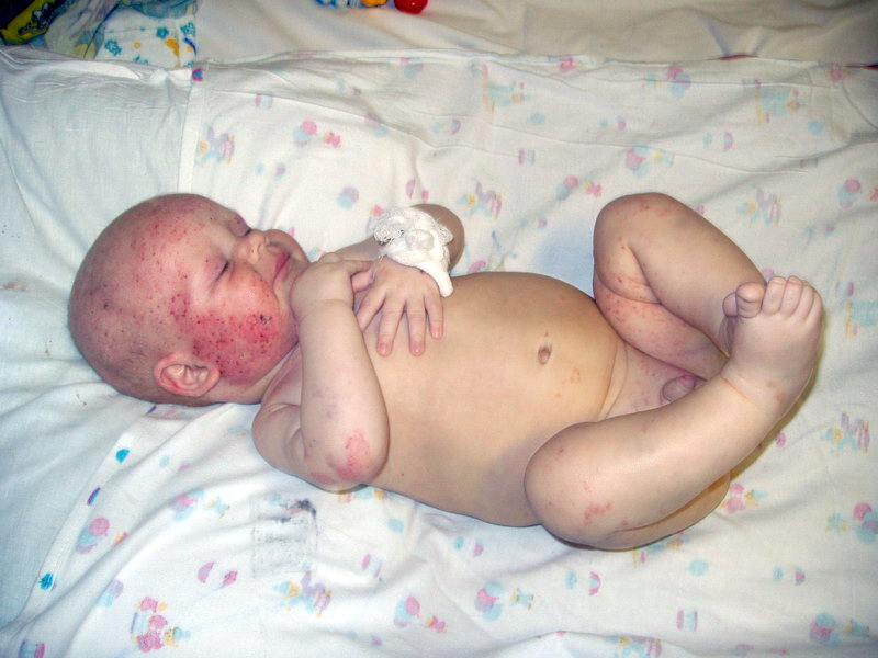 Синдром Вискотта-Олдрича