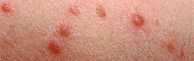 Кожные папилломы