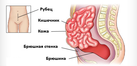 Послеоперационная грыжа