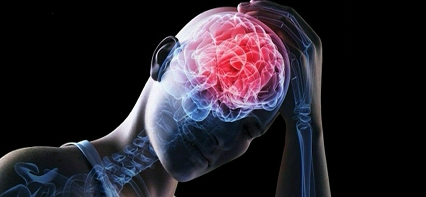 Нейросифилис