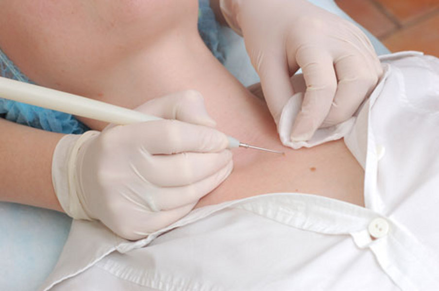 Кожные папилломы