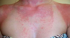 Фотодерматит