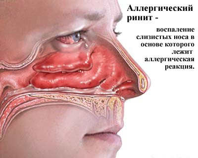 Аллергический ринит
