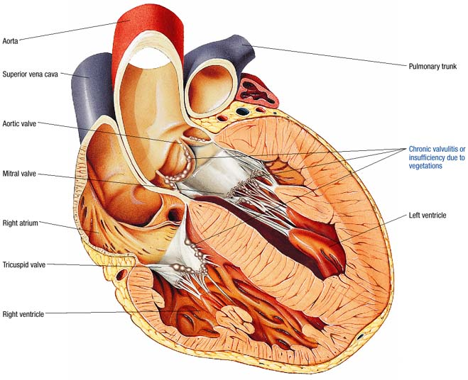 Ревматическая болезнь сердца
