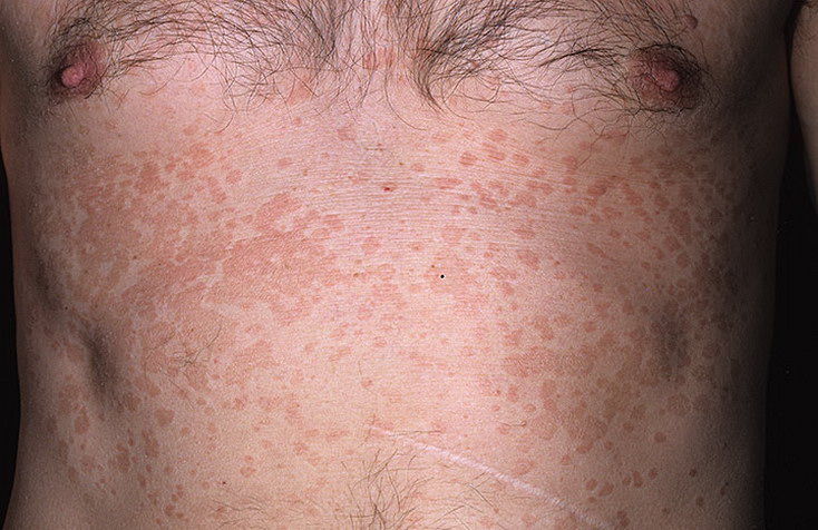 Разноцветный лишай