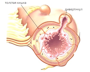 Дивертикулез
